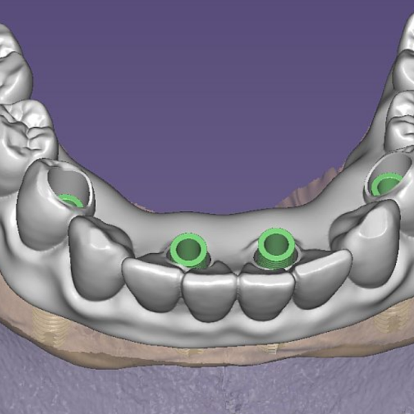 Zubní implantace pomocí chirurgické šablony